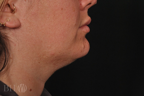 Arm Lift Before & After